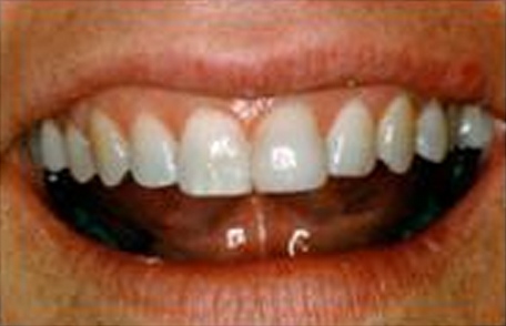 Dental Bonding - After